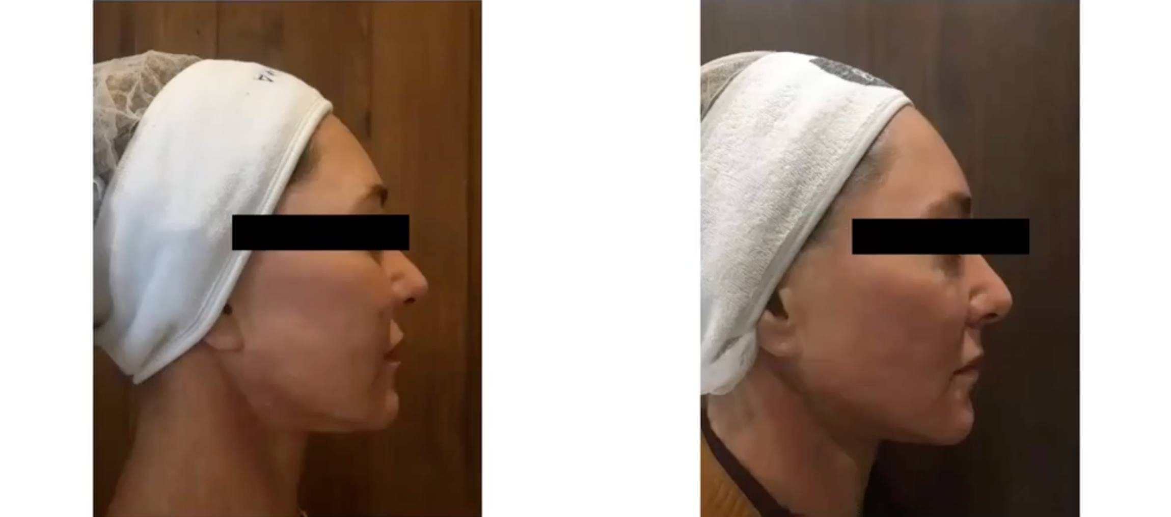 Pro Vorher Nacher2 Vorher Nachher Dermatologie Hanau